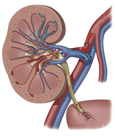 Transplanted Kidney