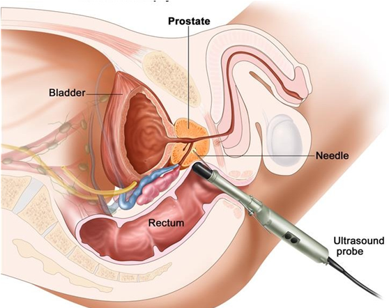 prostate cancer check)