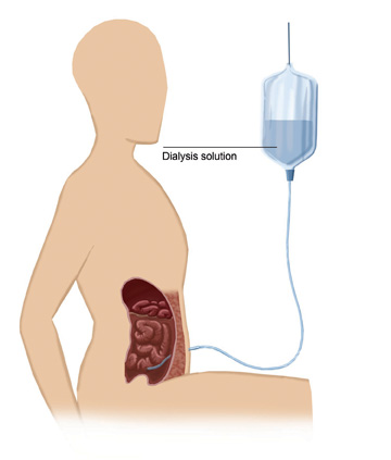 CAPD Infusion